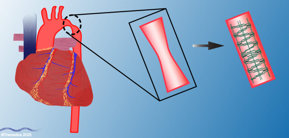 A slide showing Tremedics' award-winning technology for treating narrowed aortas in children (left). Their special dissolving stent (right) opens blocked blood vessels and then disappears as the child grows, eliminating the need for repeated surgeries and potentially helping thousands of the 40,000 U.S. babies born with heart defects annually. [Image source: Tremedics]
